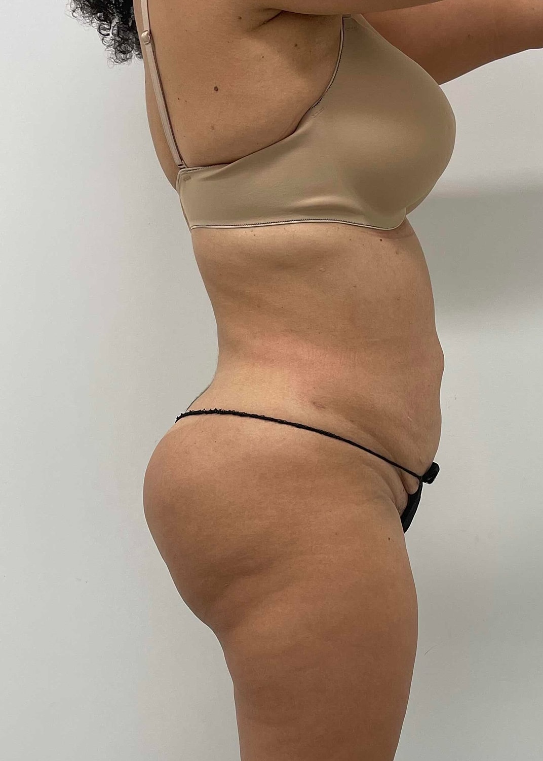 Brazilian Butt Lift Before & After