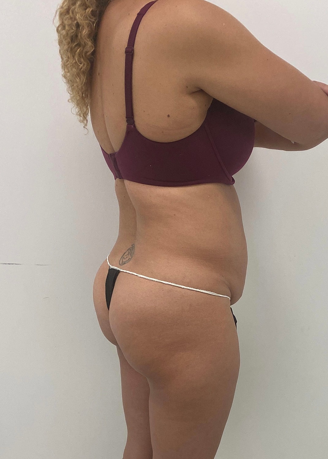 Brazilian Butt Lift Before & After