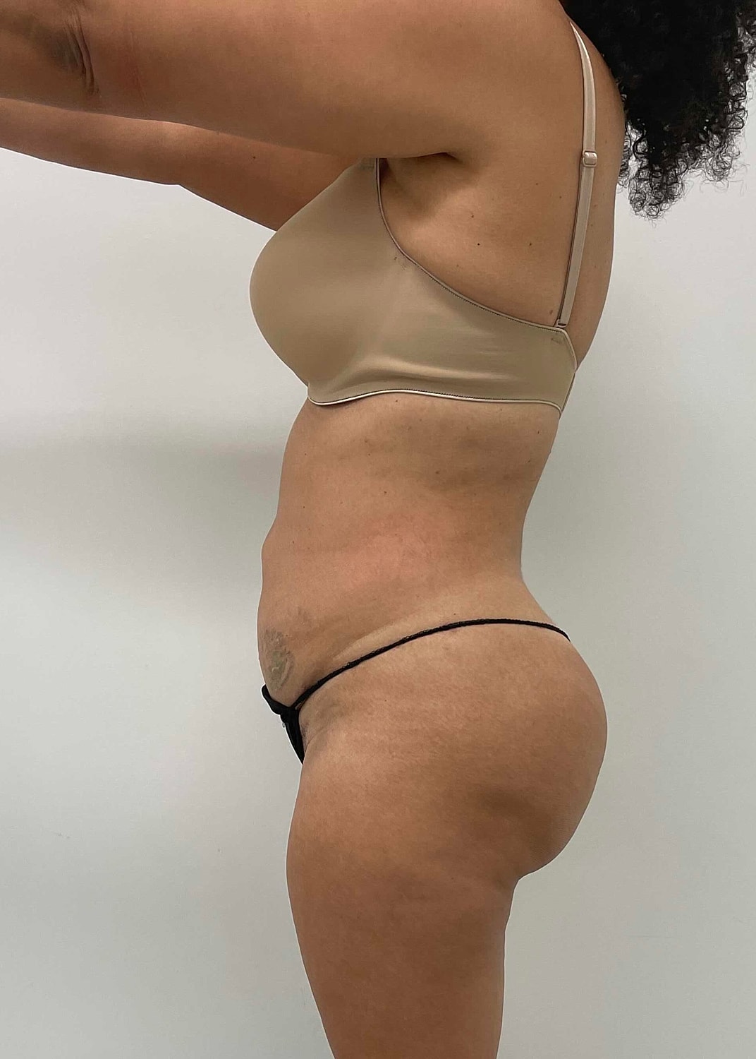 Brazilian Butt Lift Before & After