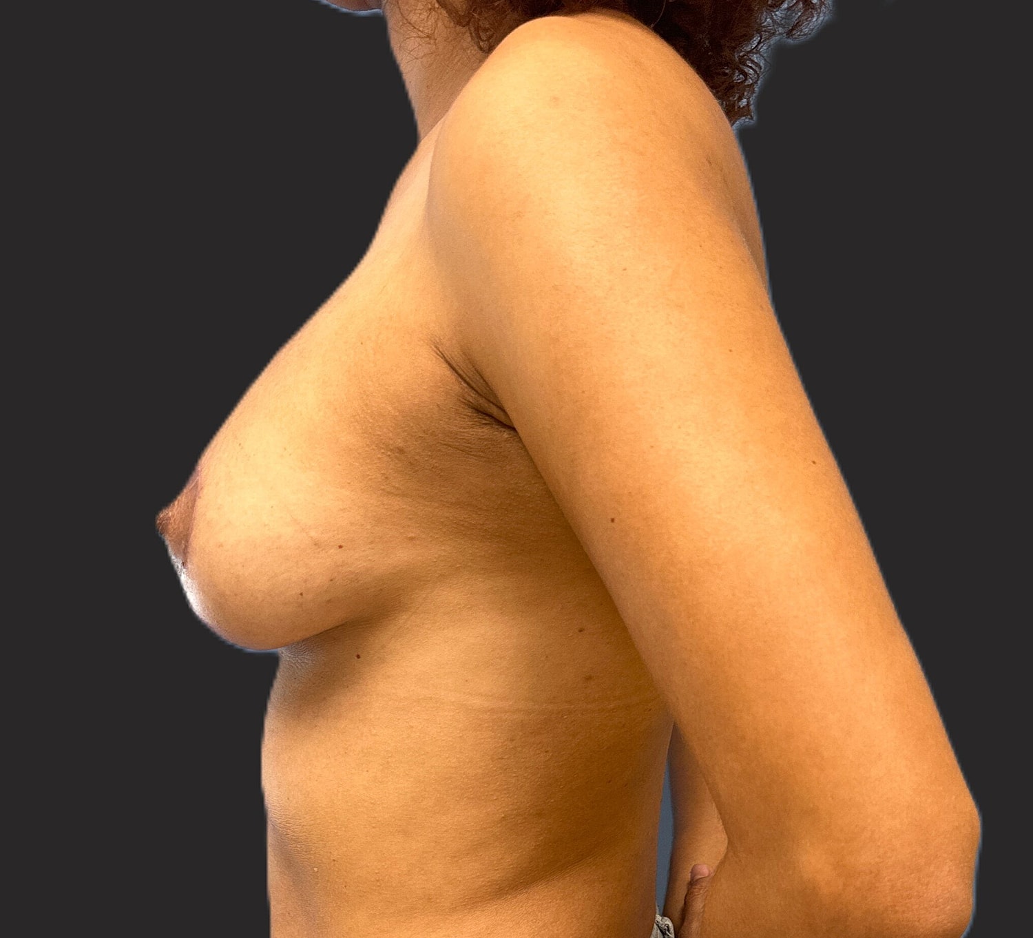 Breast Lift With Augmentation Revision Before & After