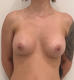 Breast Augmentation Before & After