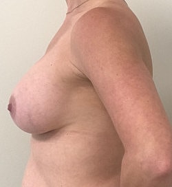 Breast Augmentation Before & After