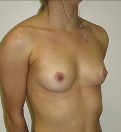 Breast Augmentation Before & After