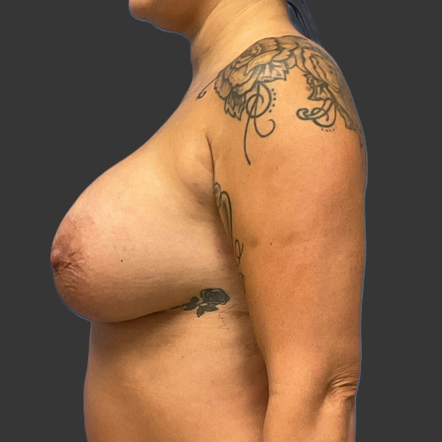 Breast Augmentation Before & After
