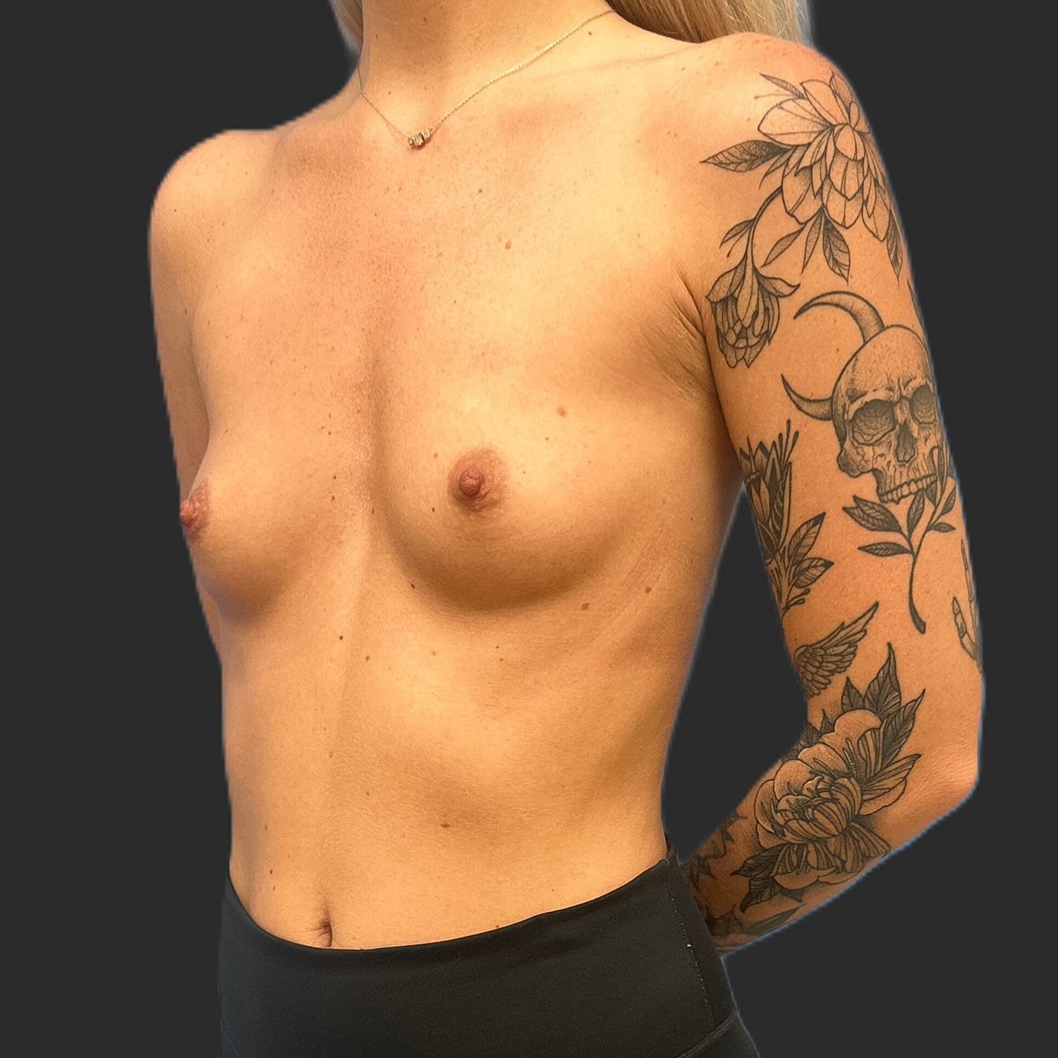 Breast Augmentation Before & After