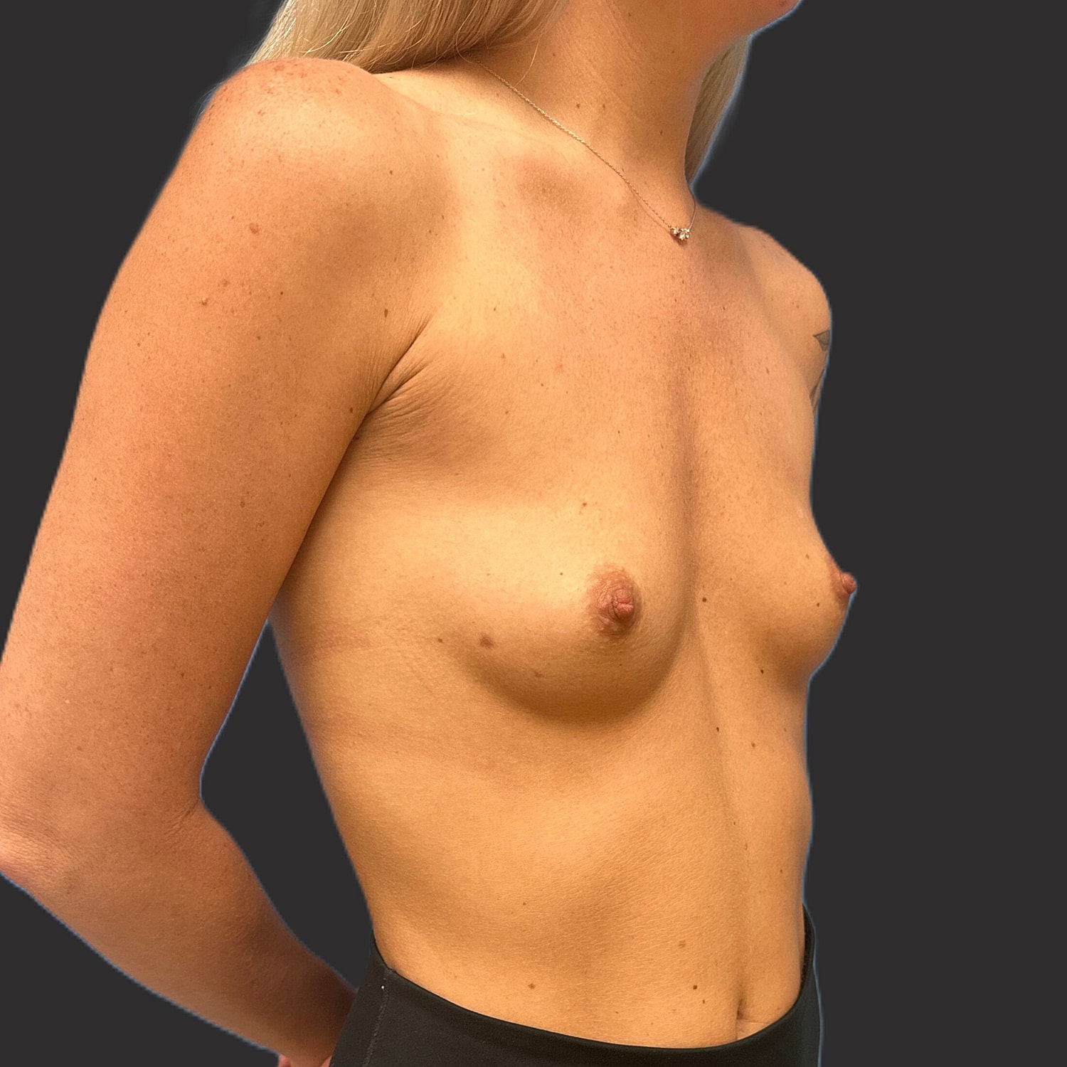 Breast Augmentation Before & After