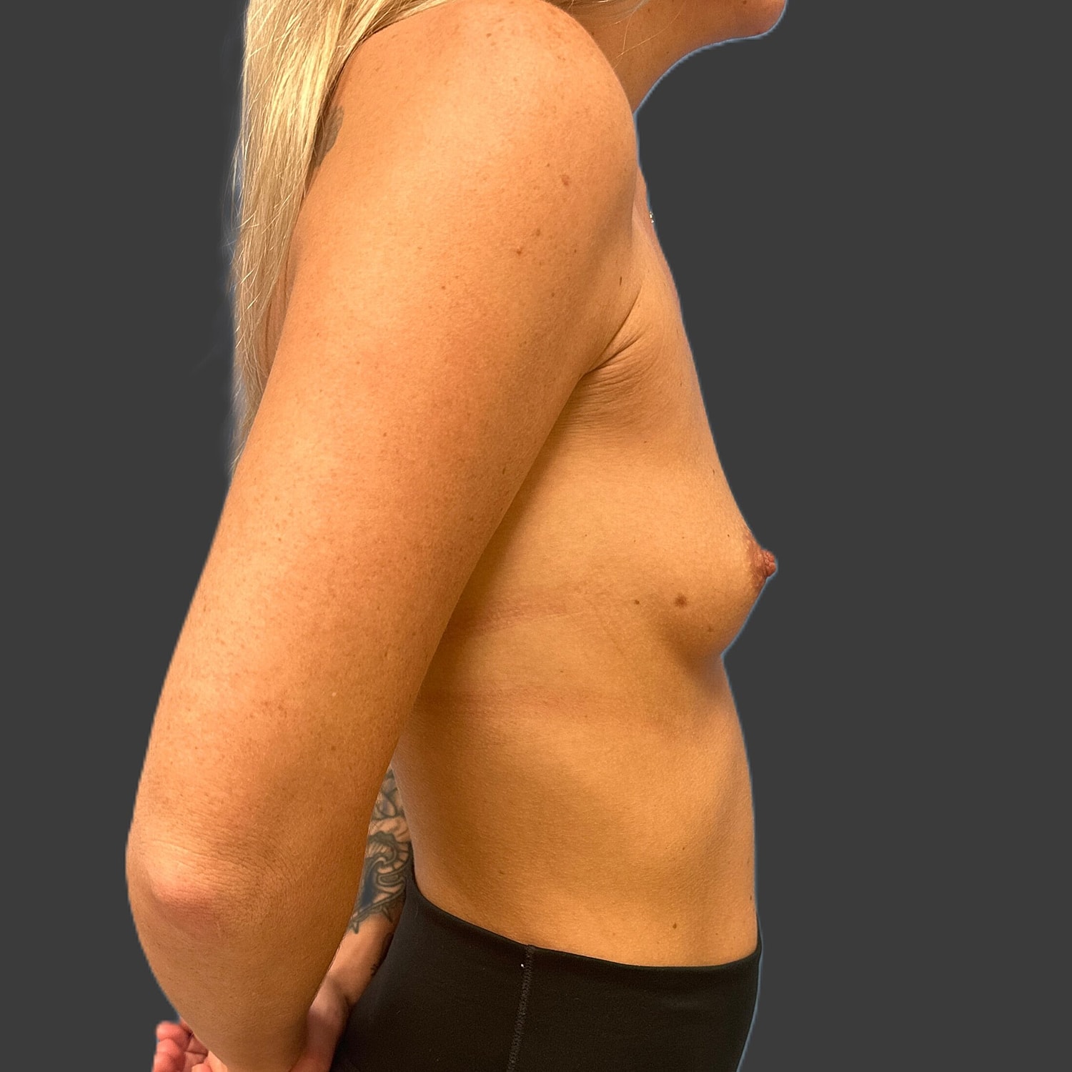 Breast Augmentation Before & After