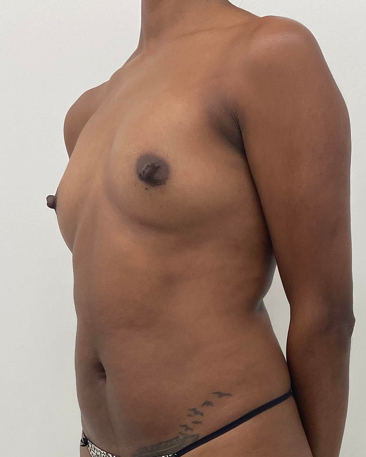Breast Augmentation Before & After