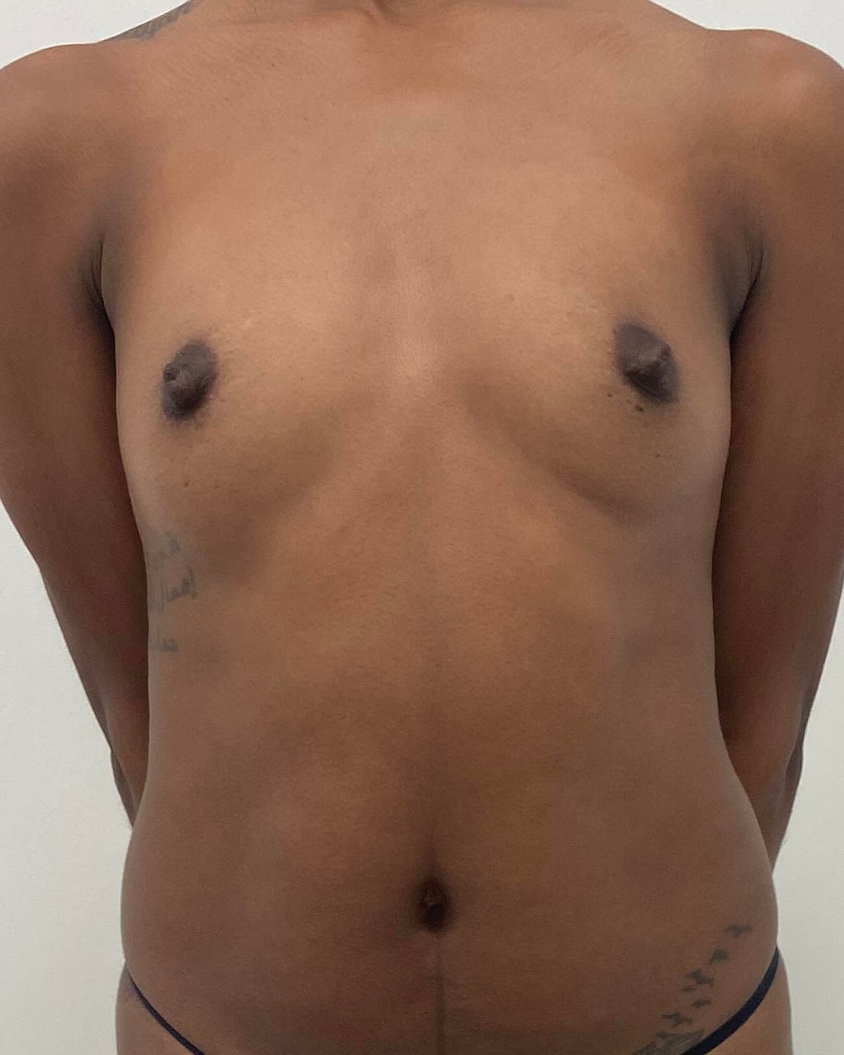 Breast Augmentation Before & After