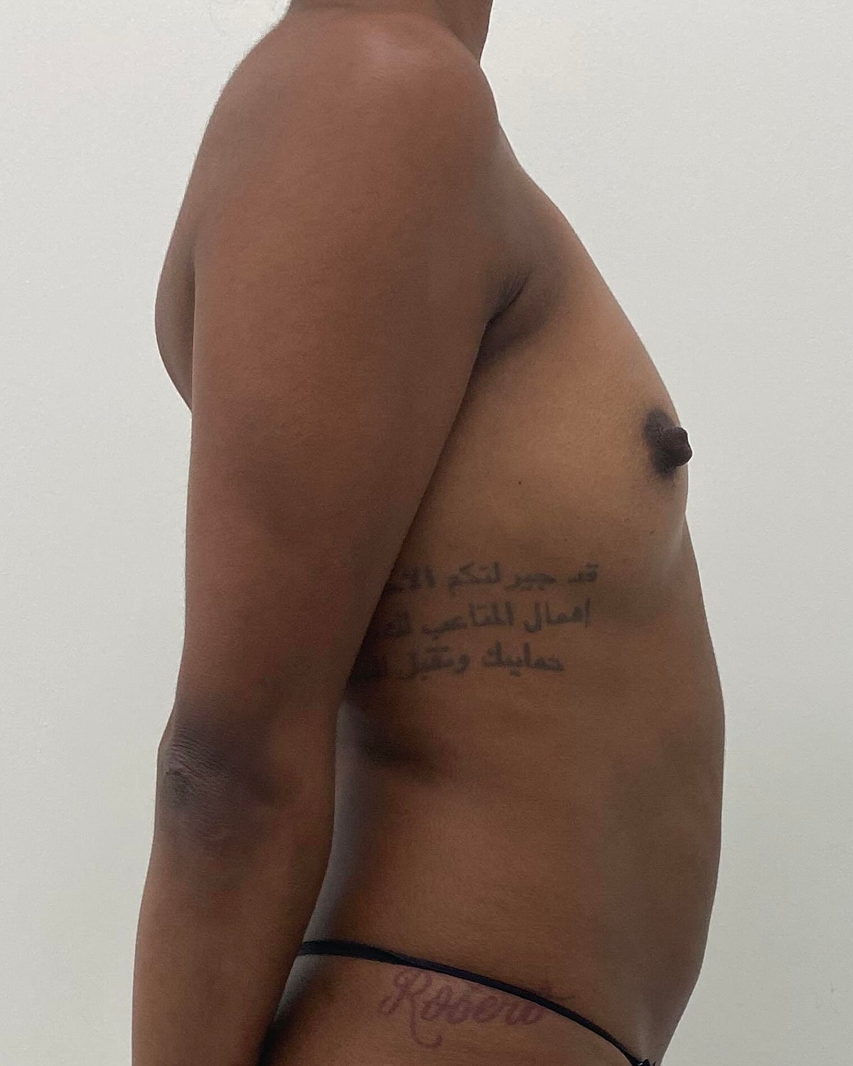 Breast Augmentation Before & After