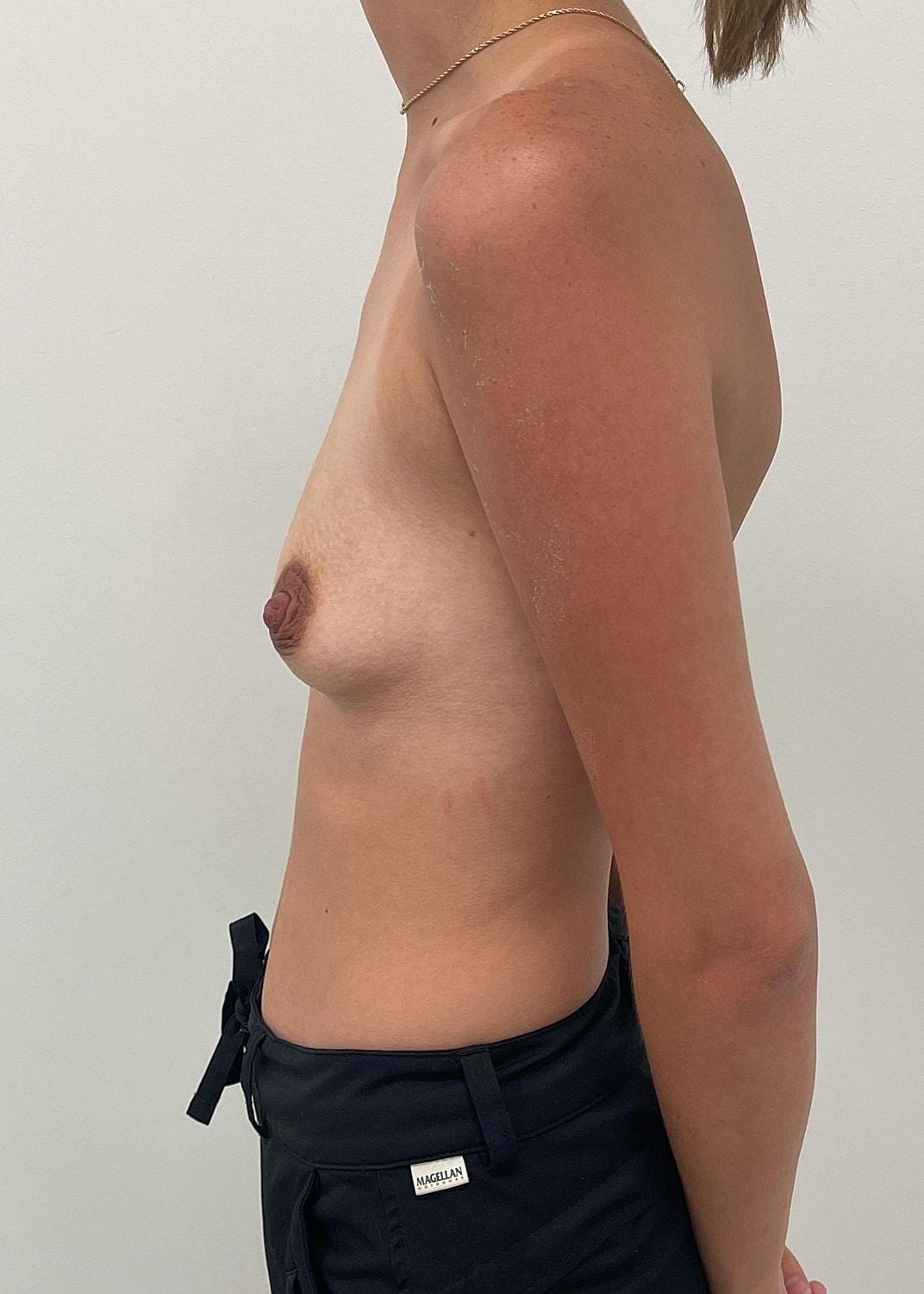 Breast Augmentation Before & After