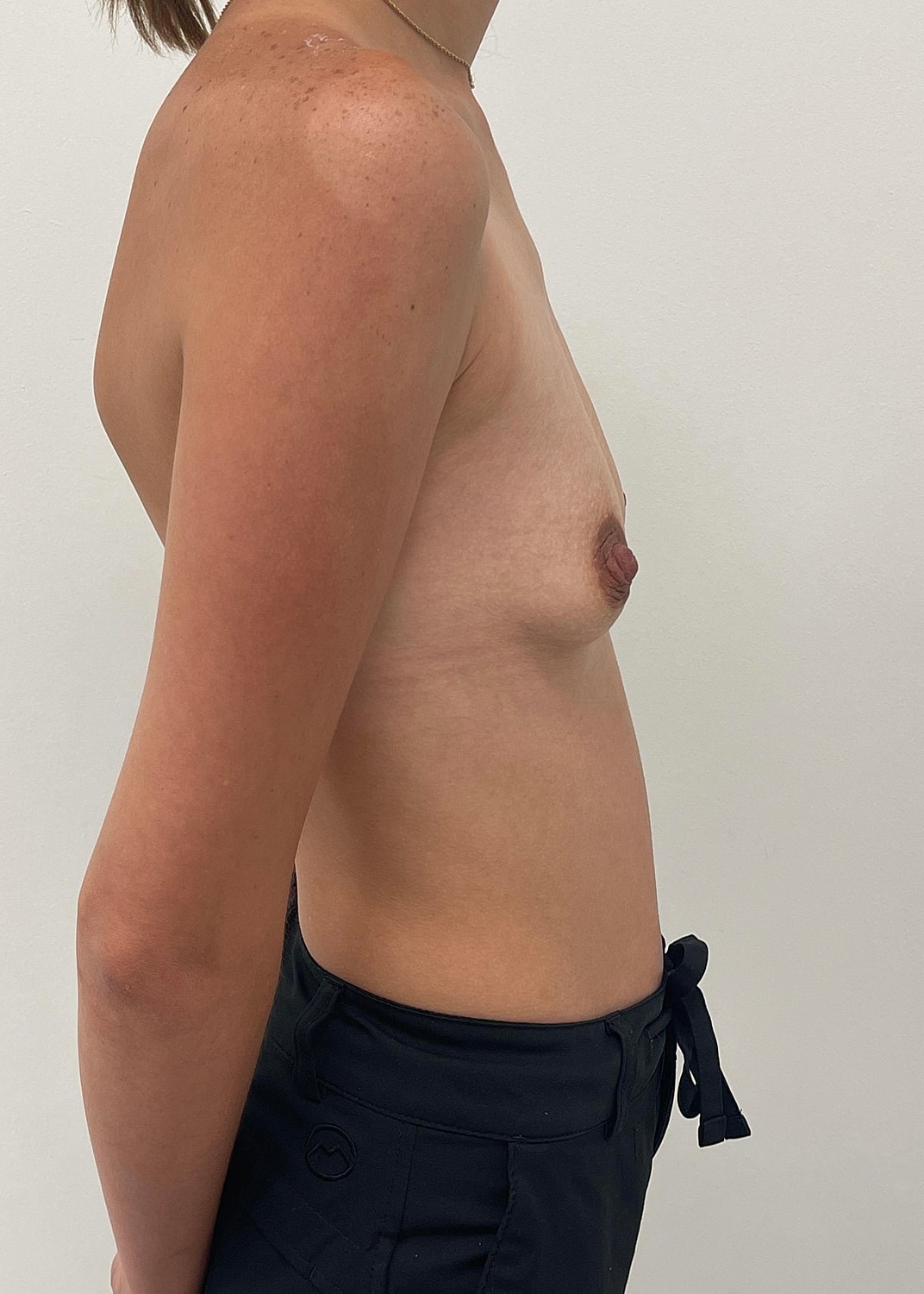 Breast Augmentation Before & After