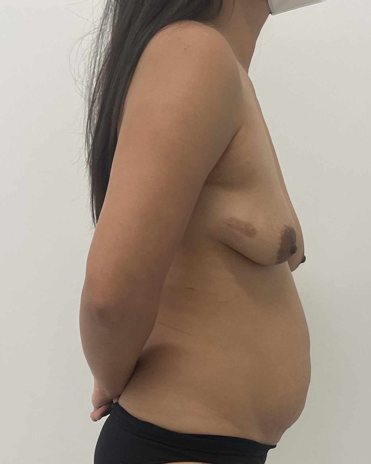 Breast Augmentation Before & After