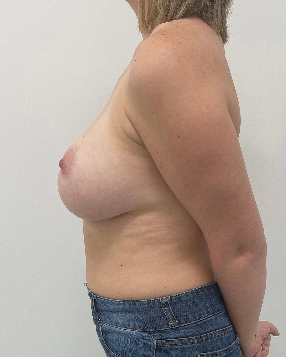 Breast Augmentation Before & After