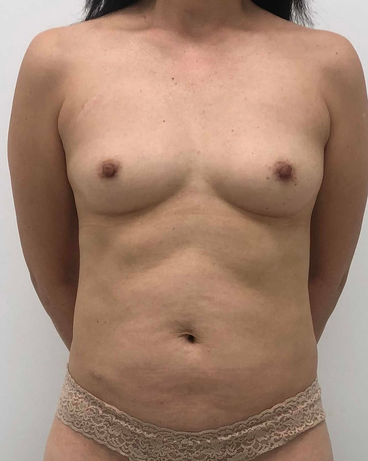 Breast Augmentation Before & After