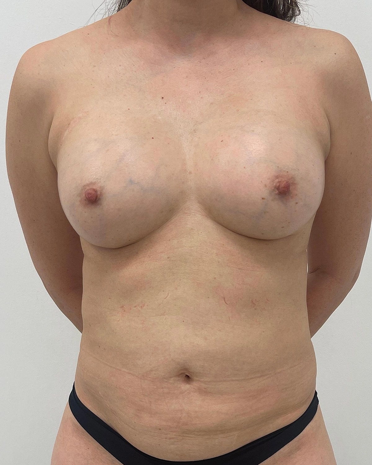Breast Augmentation Before & After