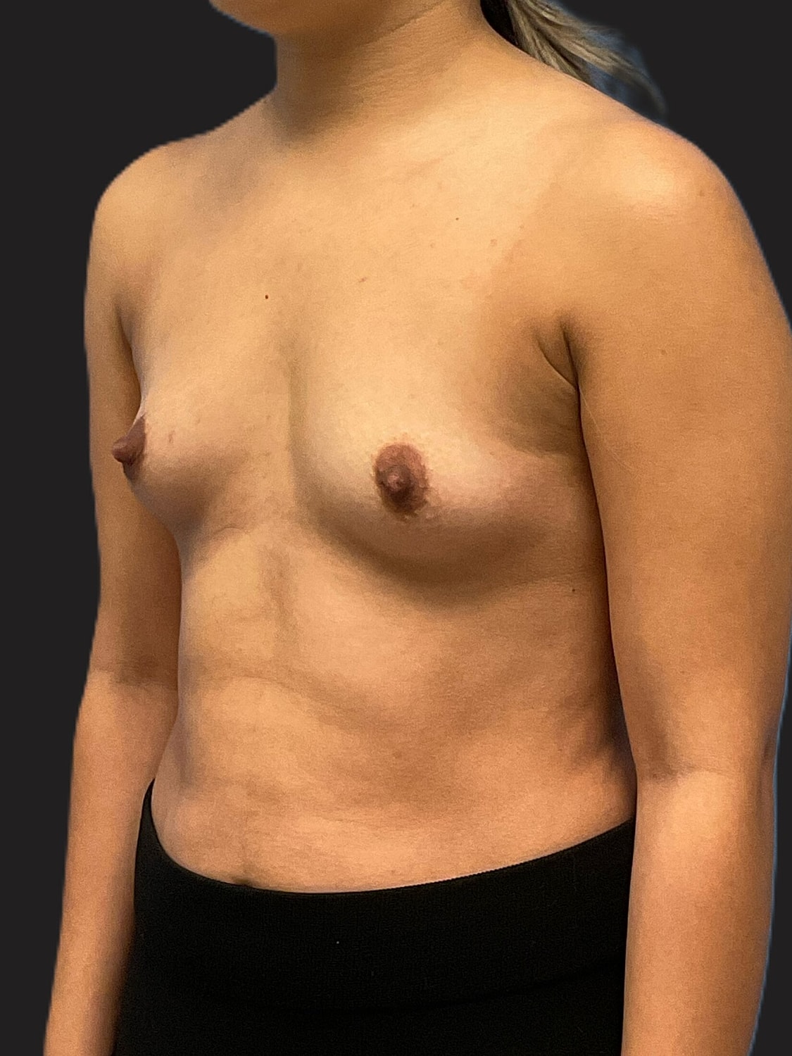 Breast Augmentation Before & After