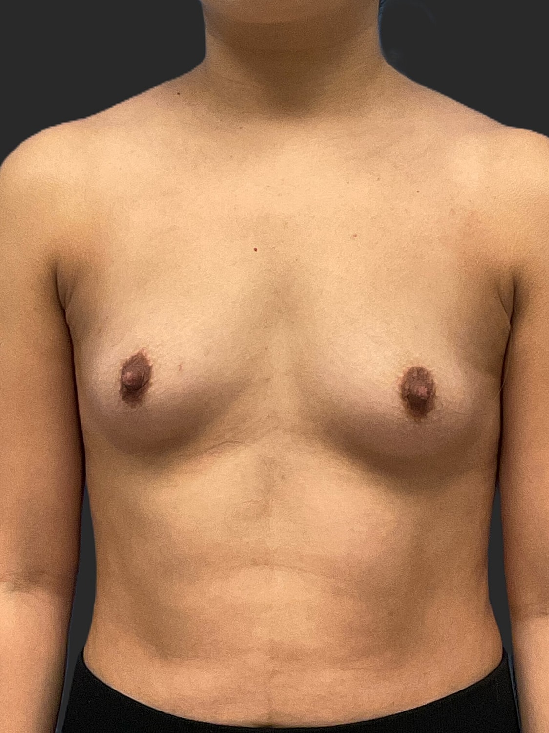 Breast Augmentation Before & After