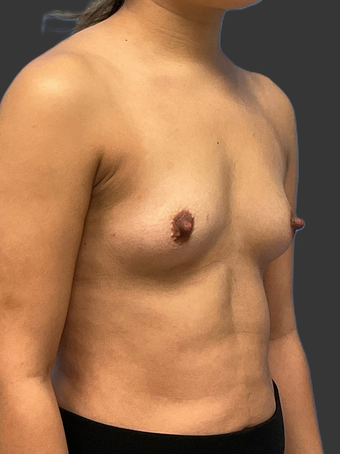 Breast Augmentation Before & After