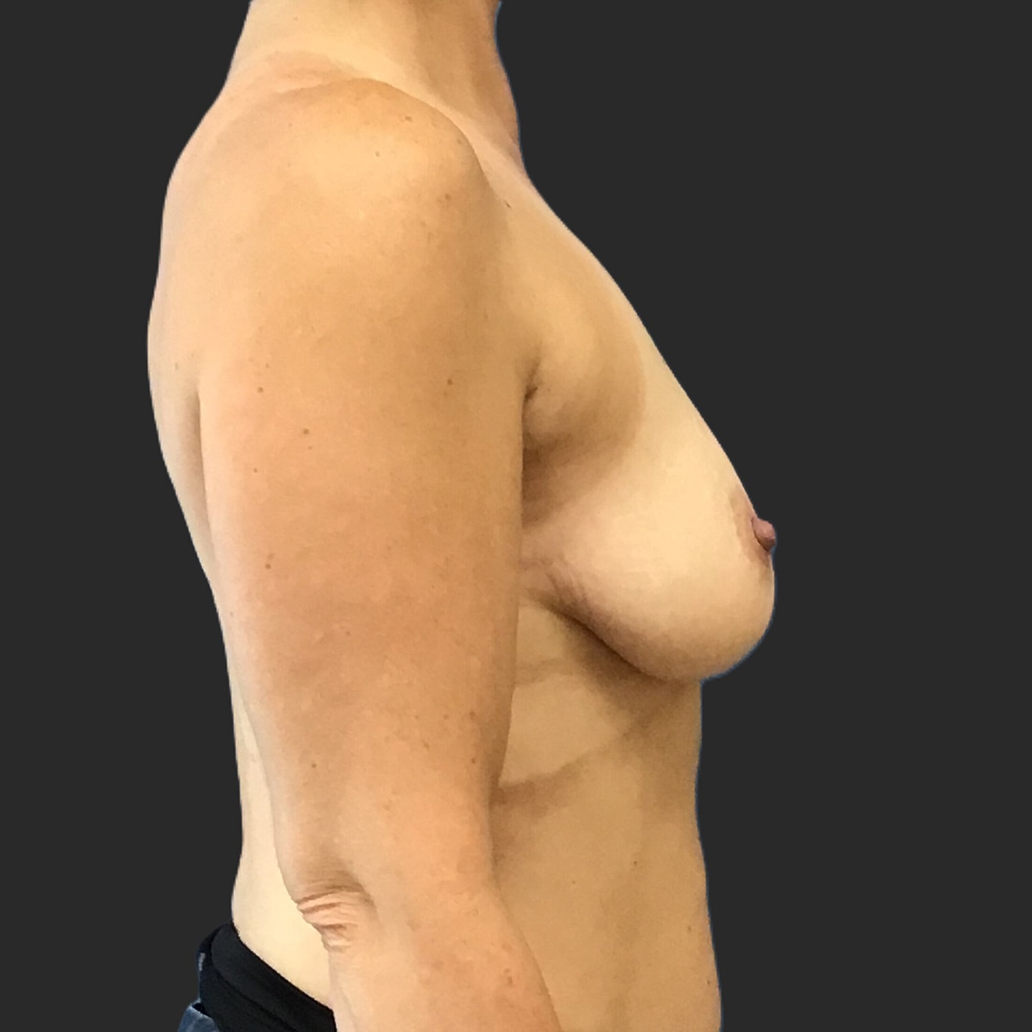 Breast Augmentation Before & After