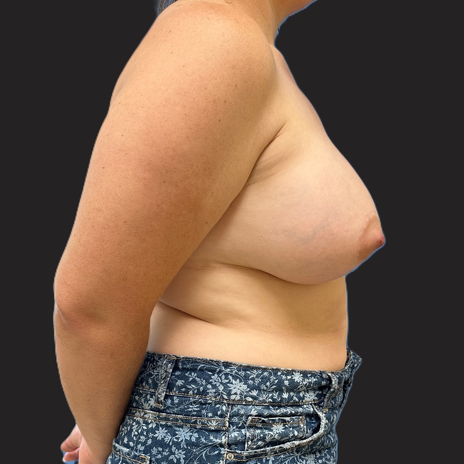 Breast Augmentation Before & After