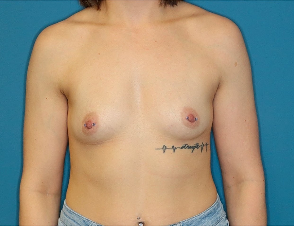 Breast Augmentation Before & After