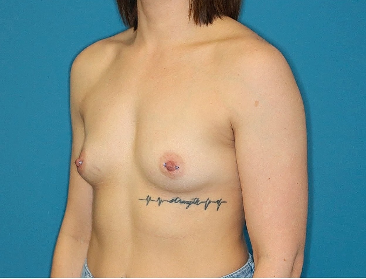 Breast Augmentation Before & After