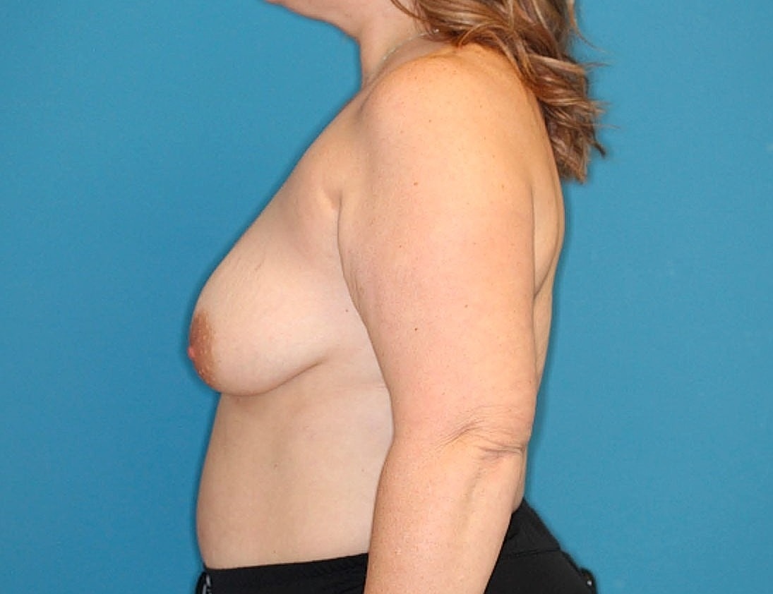 Breast Augmentation Before & After