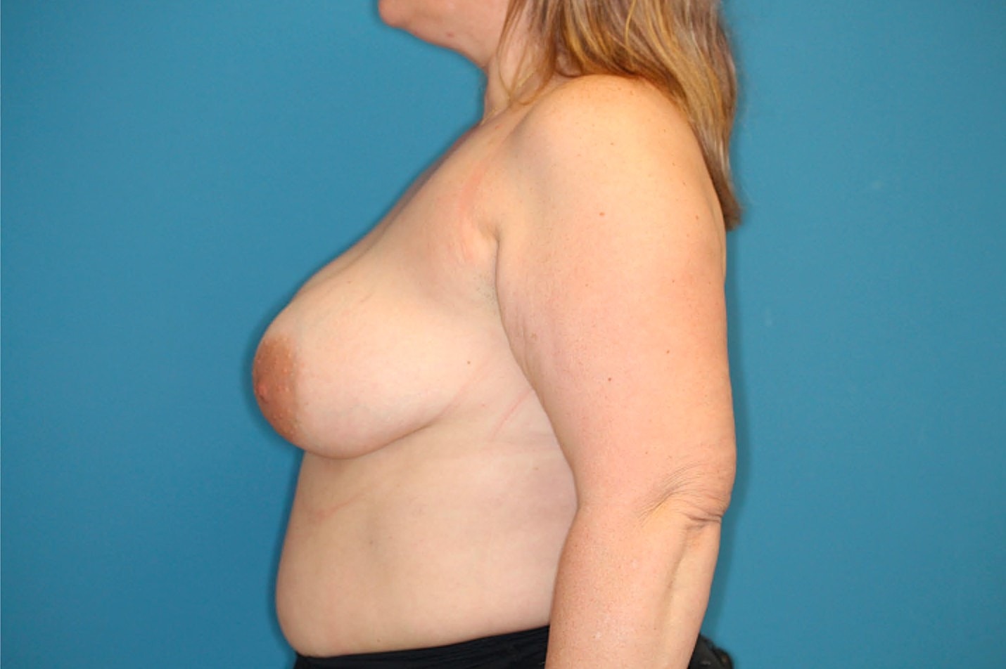 Breast Augmentation Before & After