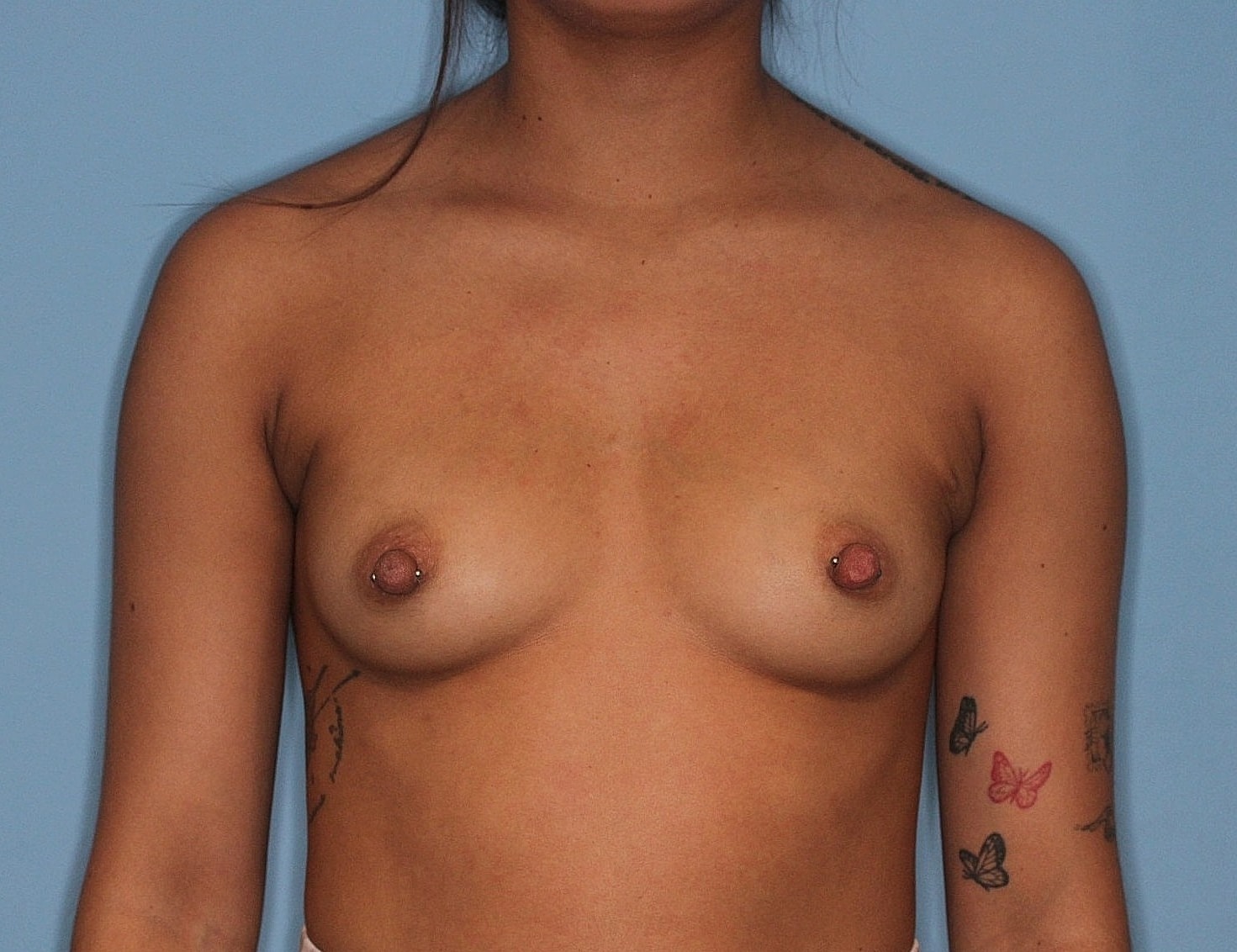 Breast Augmentation Before & After