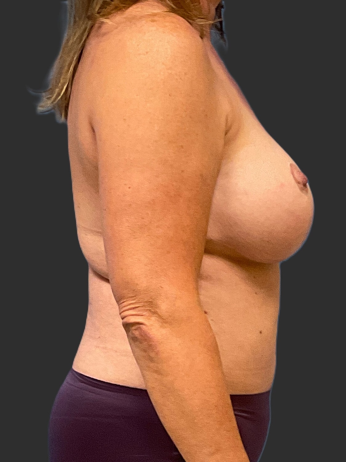 Breast Reduction Revision Before & After