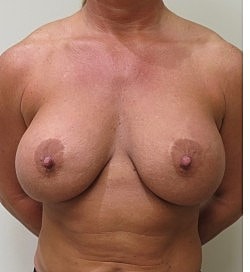 Breast Augmentation Revision Before & After
