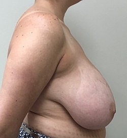 Breast Reduction Before & After
