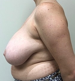 Breast Reduction Before & After