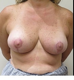 Breast Reduction Before & After