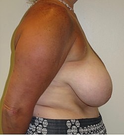Breast Reduction Before & After