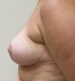 Breast Reduction Before & After