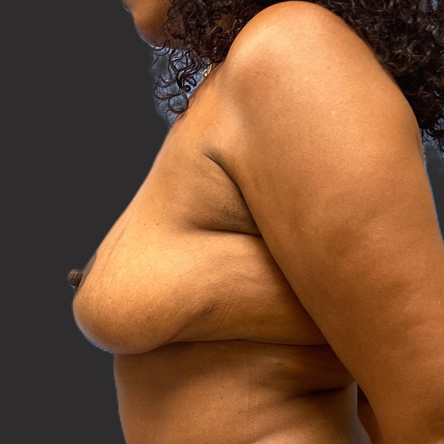 Breast Reduction Before & After