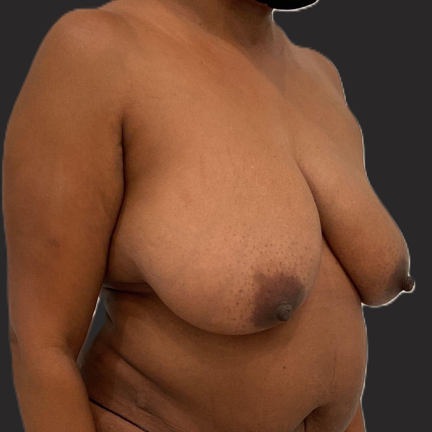 Breast Reduction Before & After