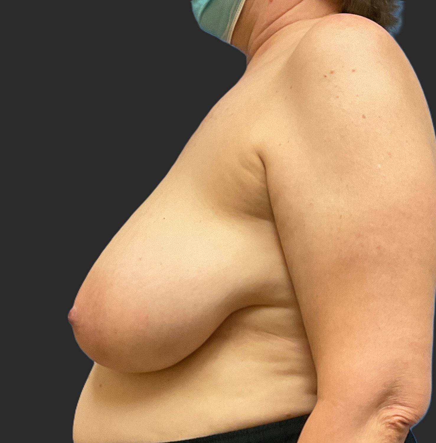 Breast Reduction Before & After