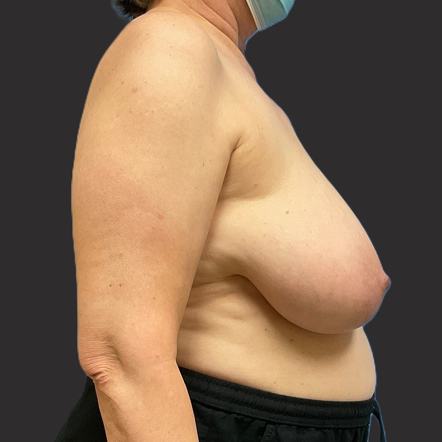 Breast Reduction Before & After