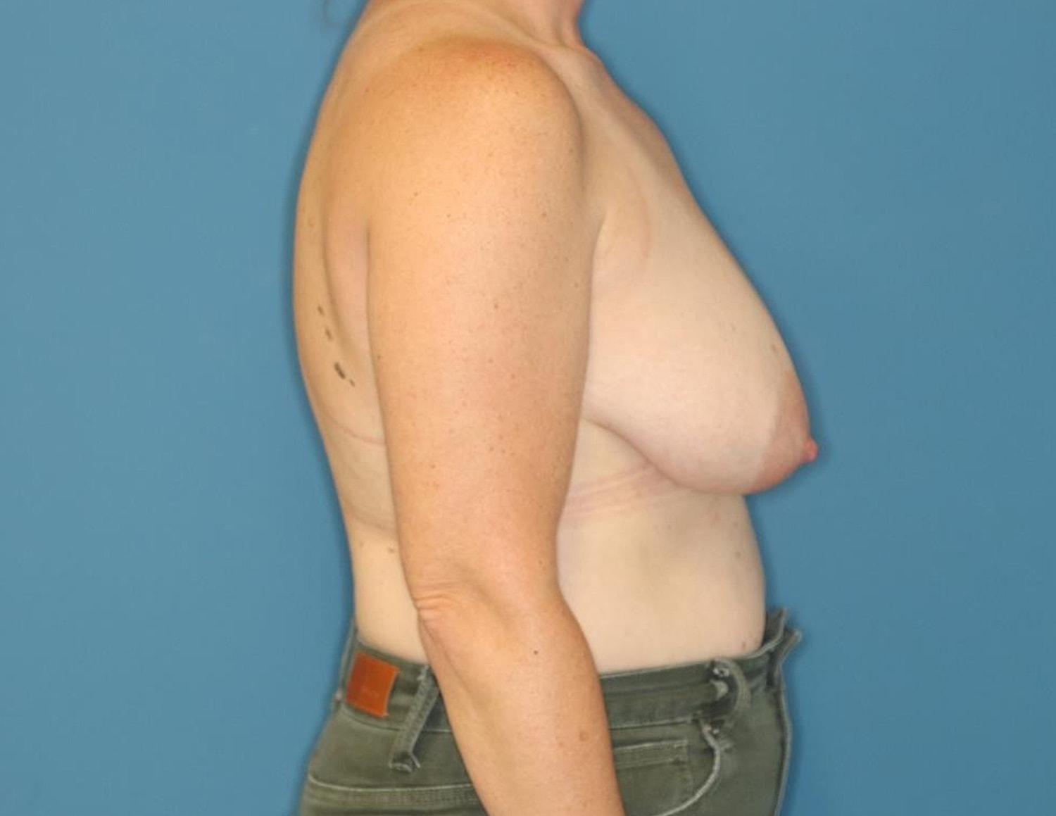 Breast Reduction Before & After