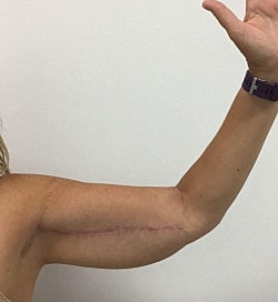 Arm Lift Before & After