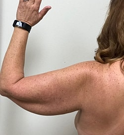 Arm Lift Before & After