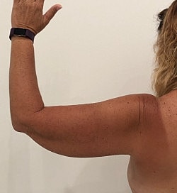 Arm Lift Before & After