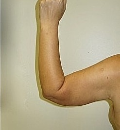 Arm Lift Before & After