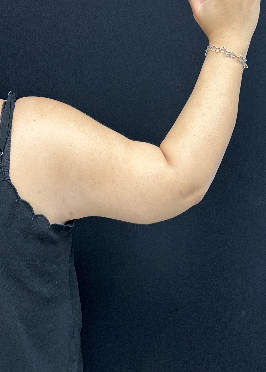 Arm Lift Before & After