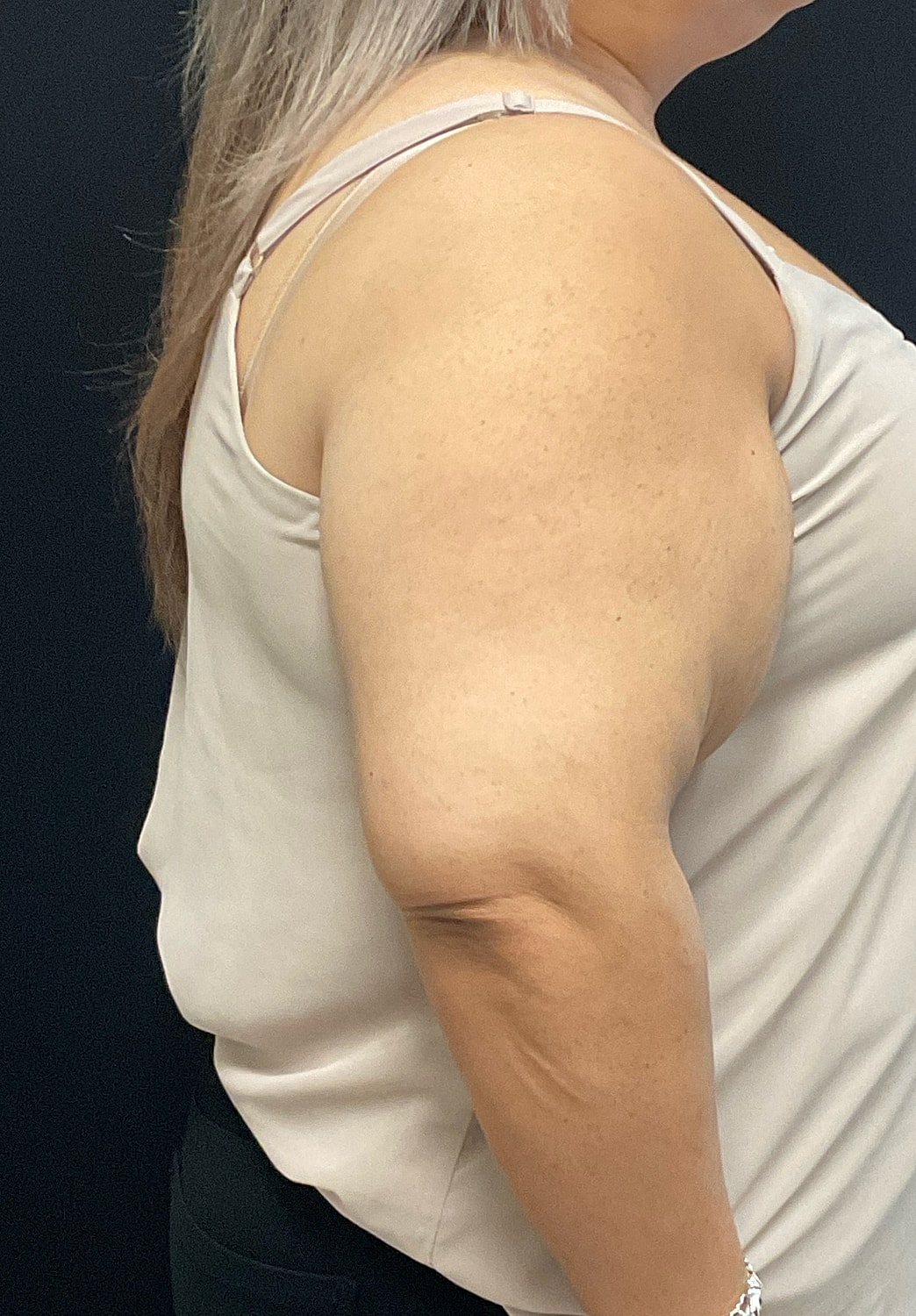 Arm Lift Before & After