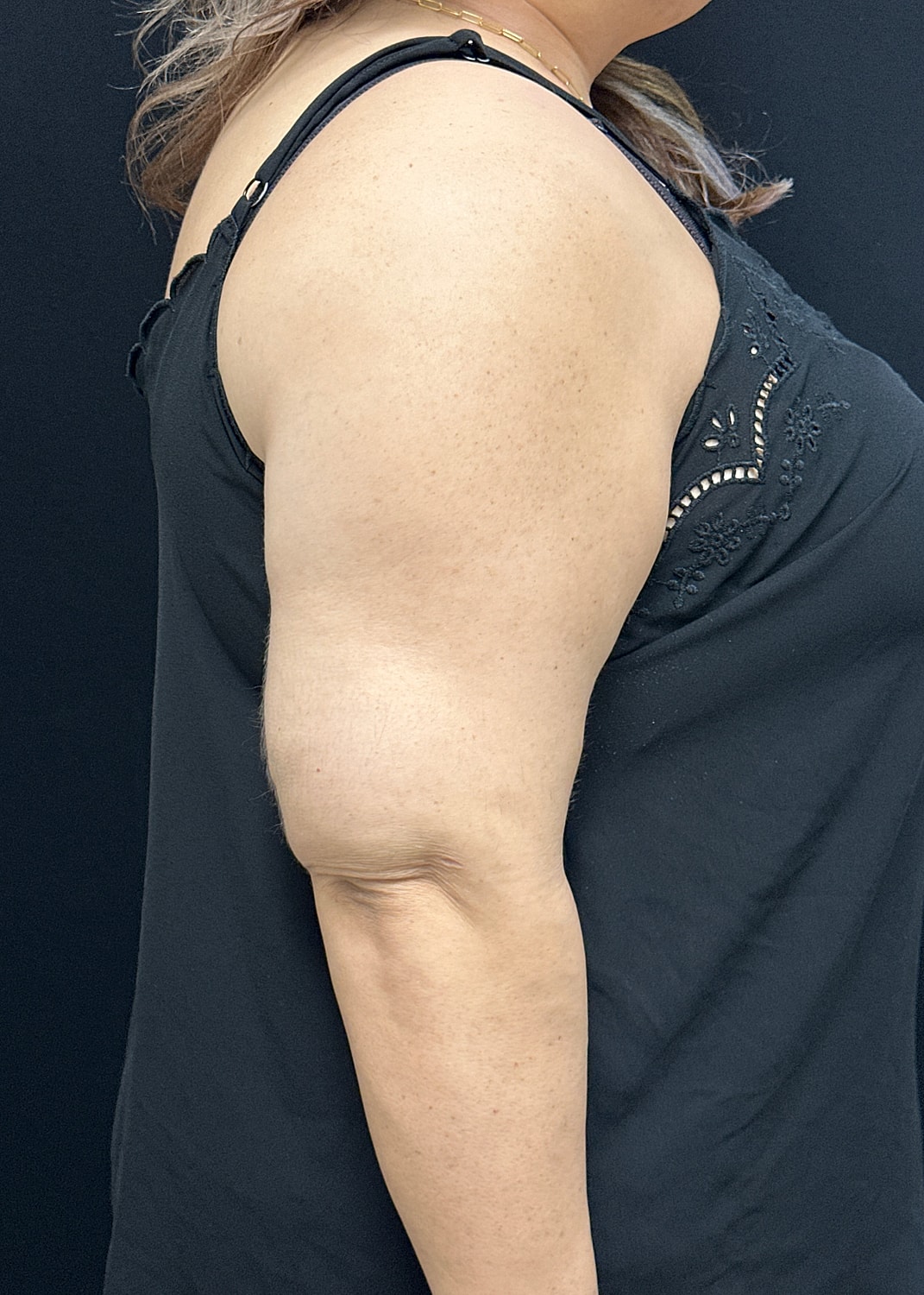 Arm Lift Before & After