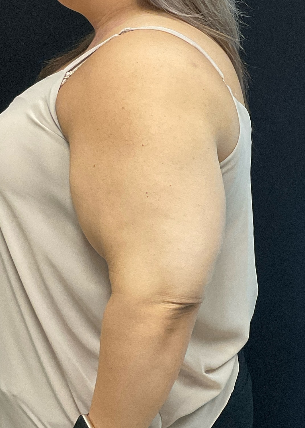 Arm Lift Before & After